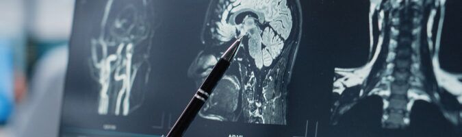 doctor pointing injury seen in x-ray of brain scan